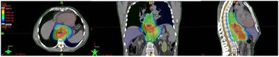 Feasibility and Oncological Outcome of Preoperative Chemoradiation With IMRT Dose Intensification for Locally Advanced Esophageal and Gastroesophageal Cancer